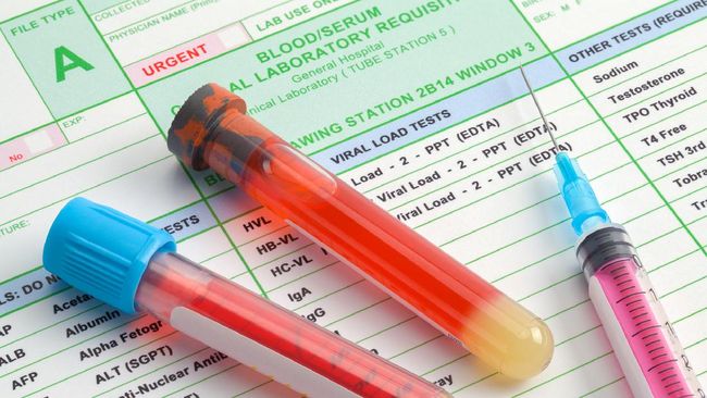 Golongan darah tertentu ternyata berisiko lebih tinggi mengalami stroke di usia muda