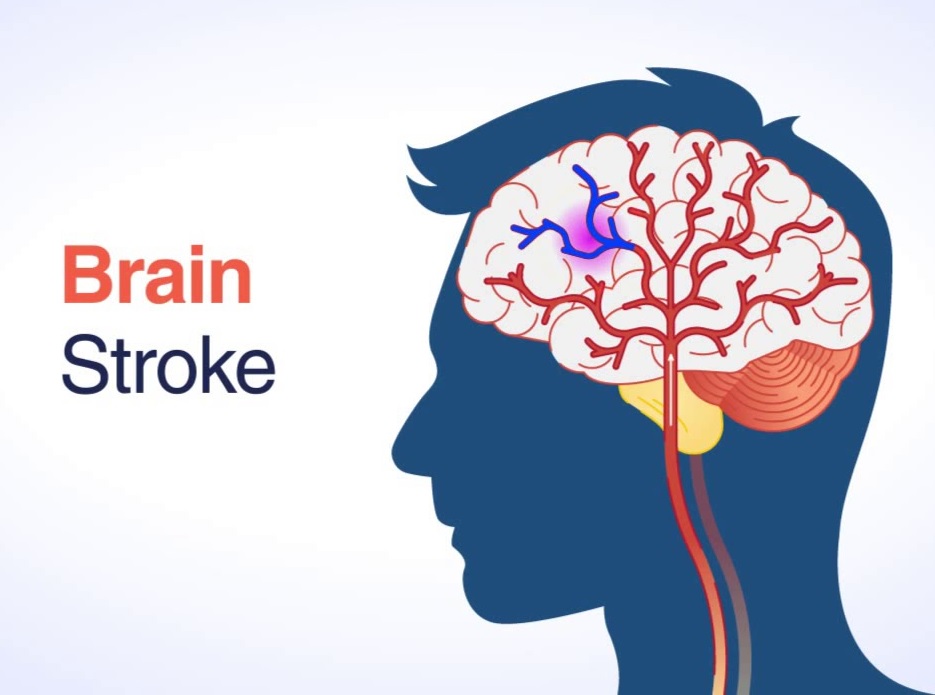 Tanda-Tanda Awal Stroke yang Dapat Terjadi