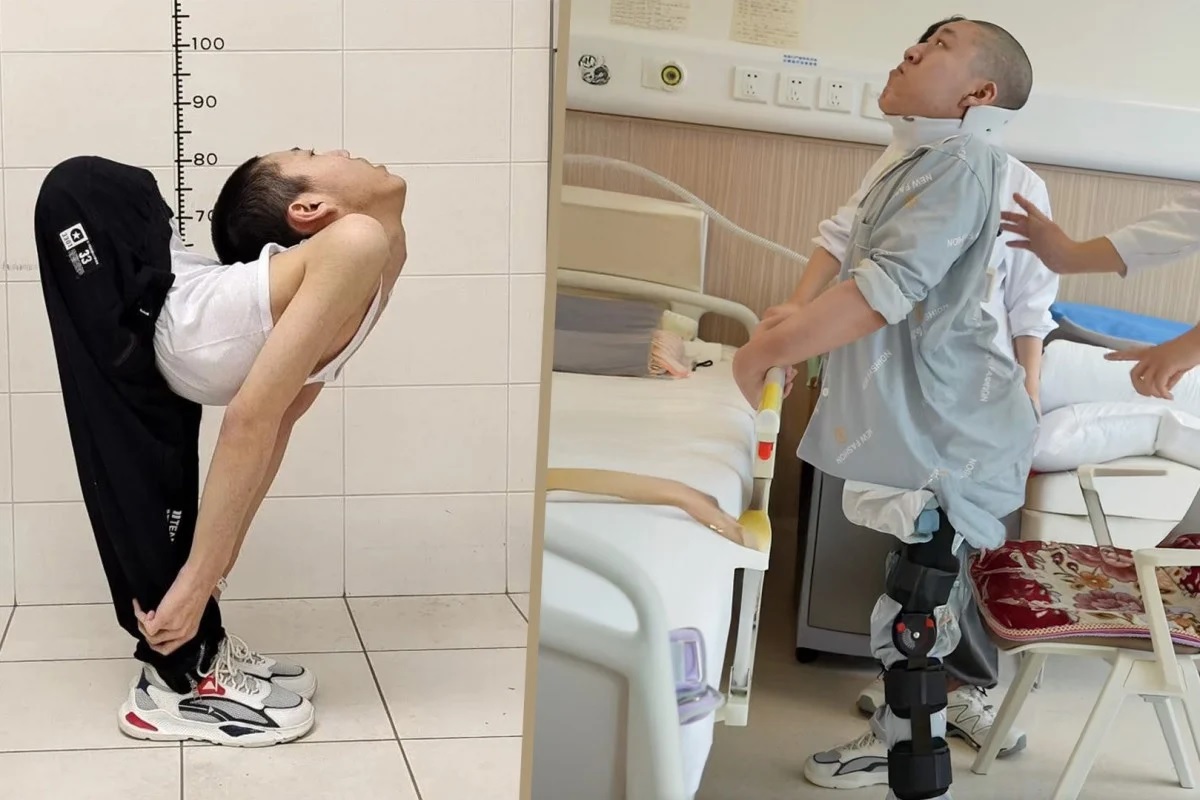 Bocah Tiongkok yang 'Terlipat' Berdiri Tegak untuk Pertama Kalinya